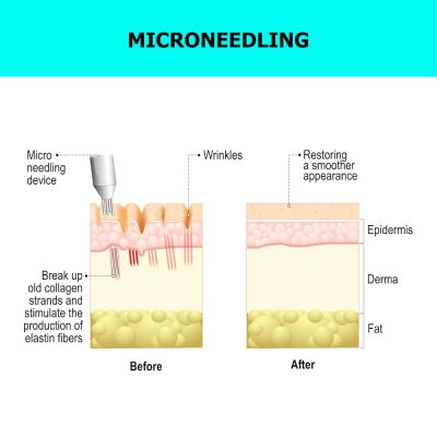 Amanda's Wellness Microneedling Plant City, Fl 33563